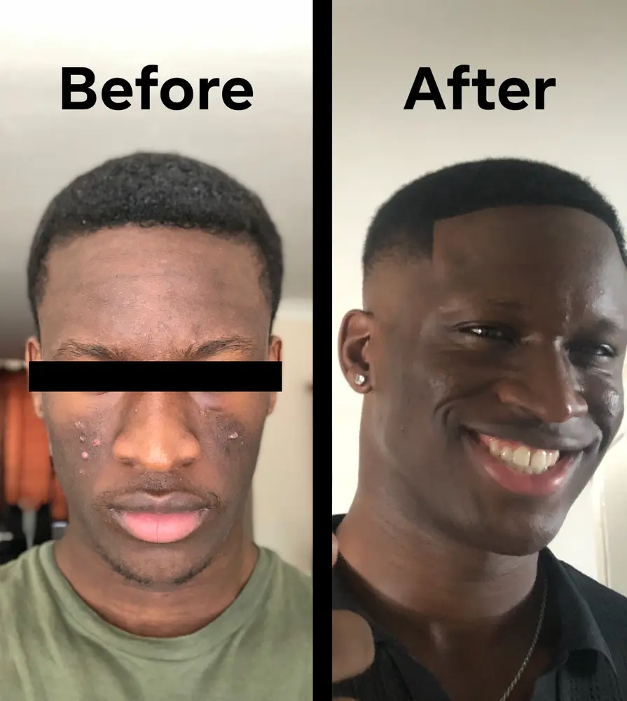 Before: hyperpigmentation treatment customer photo from Tunmise