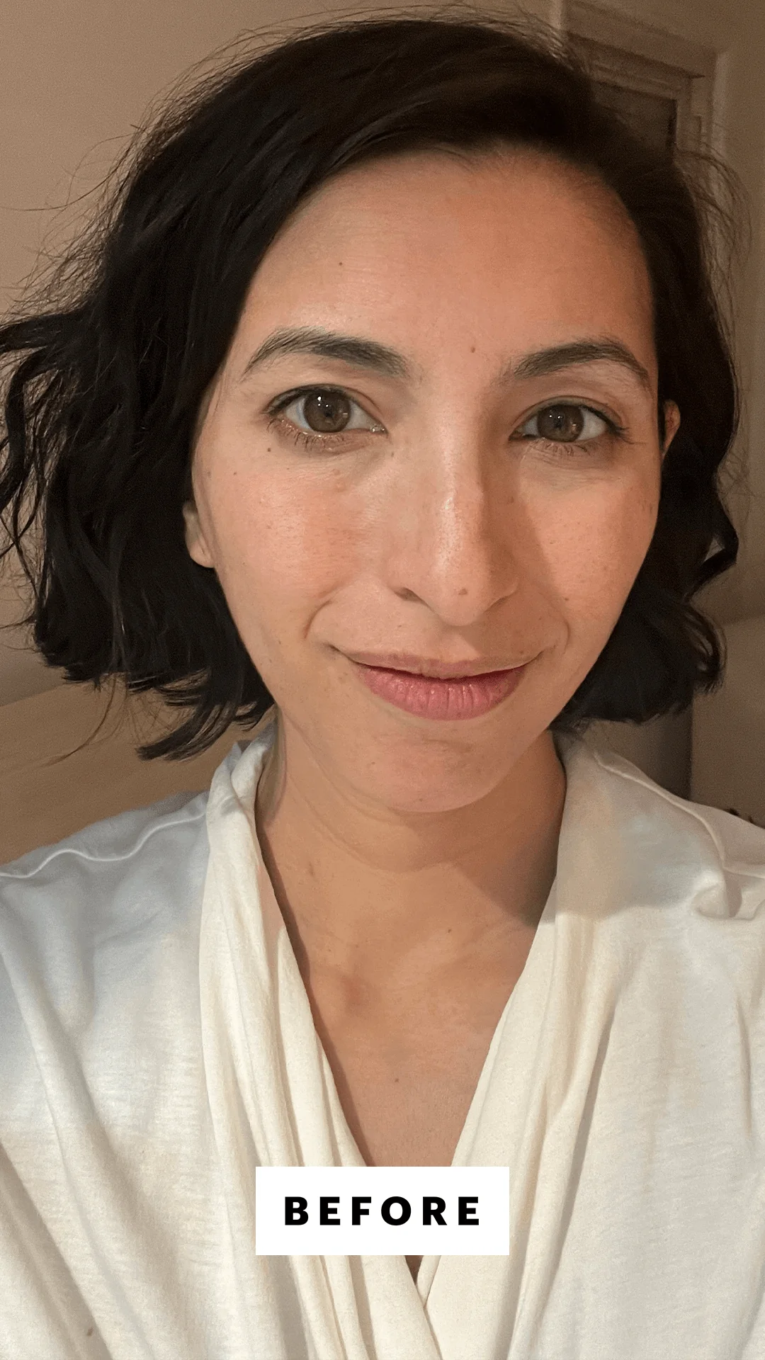 Before and after mandelic acid skin improvement