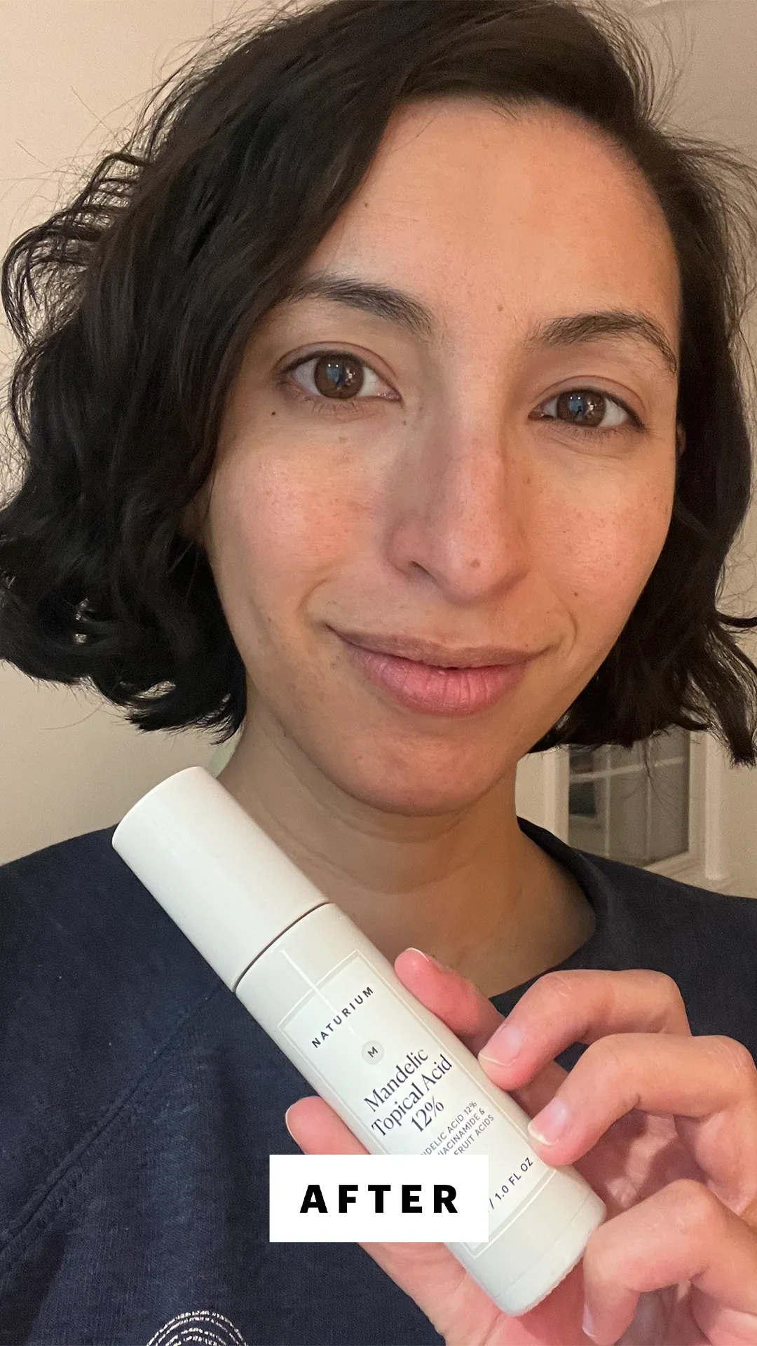 After mandelic acid skin improvement